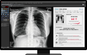 Promedius 凭借人工智能驱动的骨质疏松症筛查解决方案获得认可