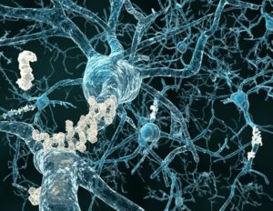 AI 帮助揭示基因在阿尔茨海默病中的隐藏作用