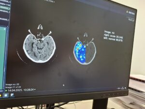 AI 帮助拉脱维亚医生诊断中风