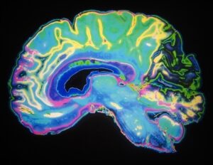 基于 AI 的新型脑图谱工具获得 FDA 批准，可用于神经外科