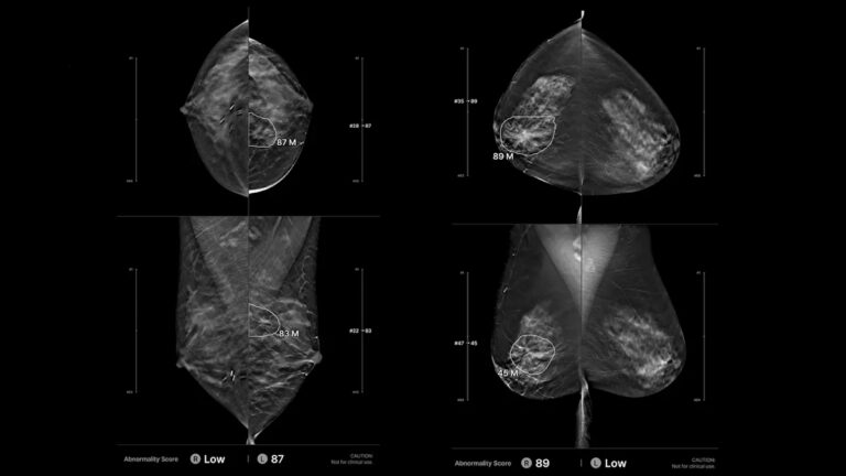 人工智能拾取扫描遗漏的间期乳腺癌